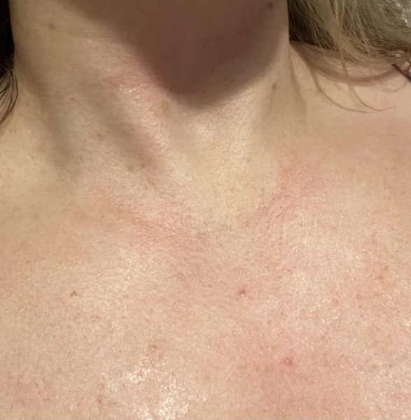 To ask what this rash could be..??
