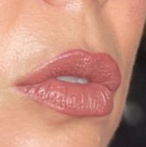 We haven't had a lip filler thread this week