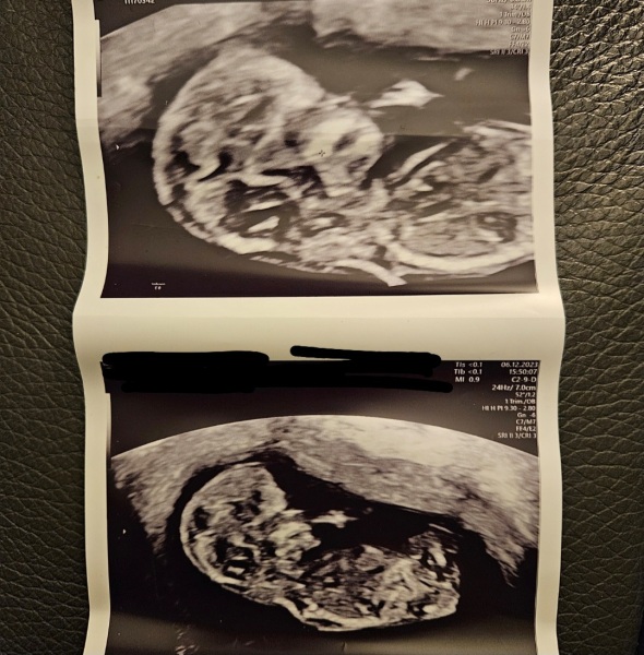 Based on nub theory- boy or girl?!