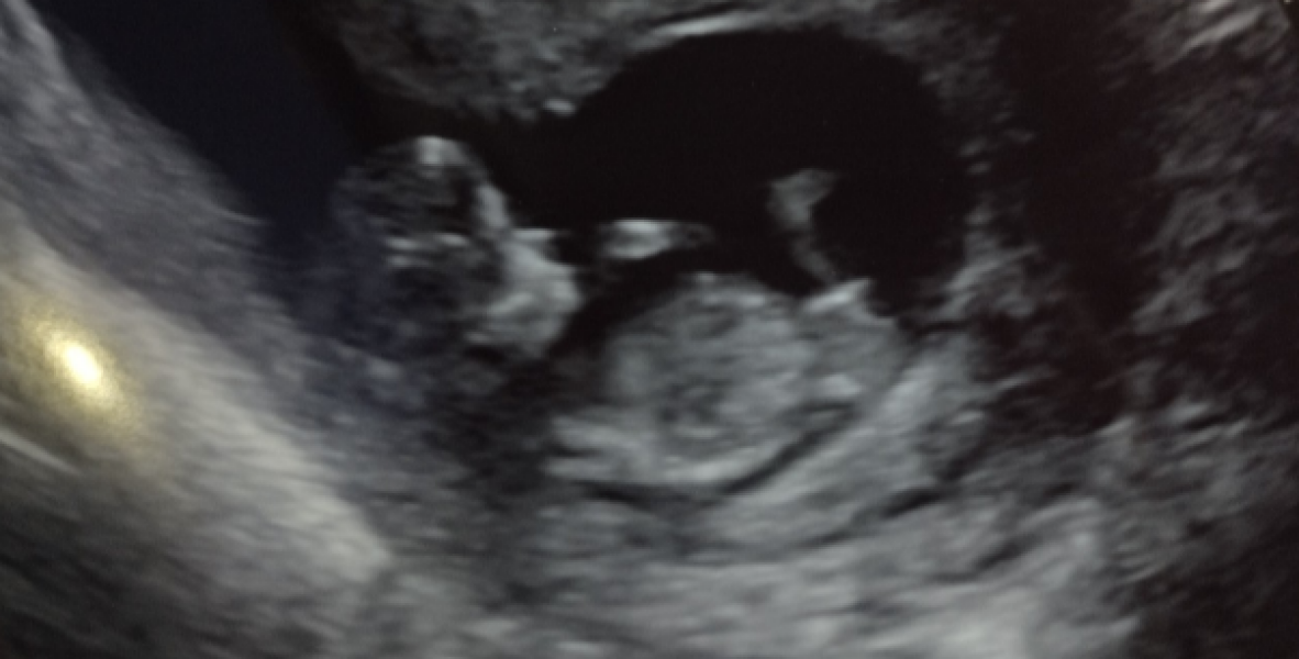 Girl or boy!? 11 week scan picture