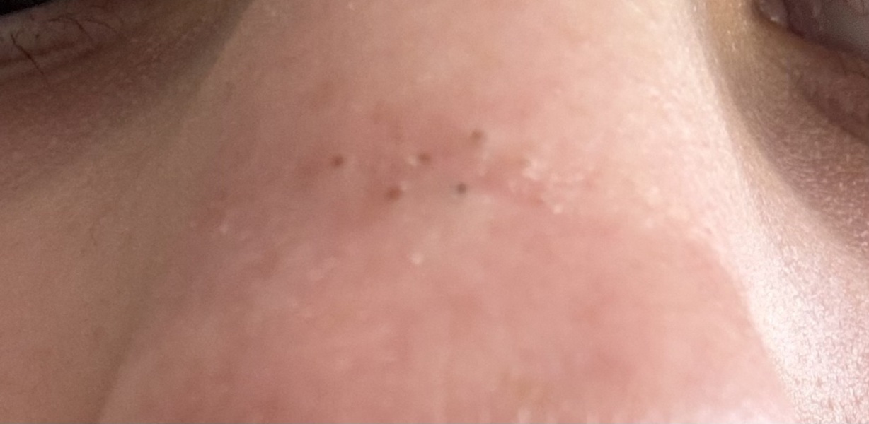 Blackheads that are not blackheads?!