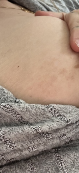 Melasma/darker patches of skin on breast
