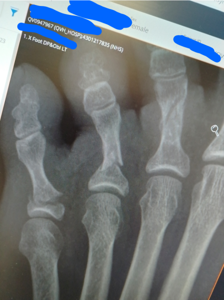 Who's broken their little toe ?