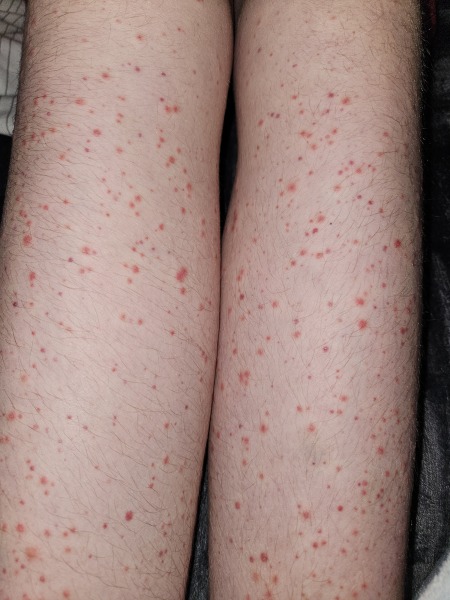 Rash on legs help.