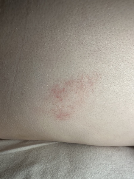 Rash but no other symptoms