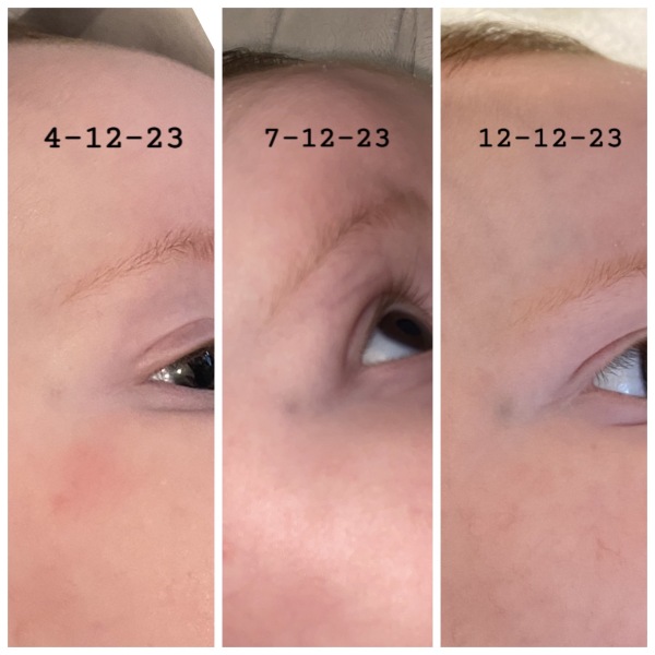 Bruise like mark/lump next to babys right eye