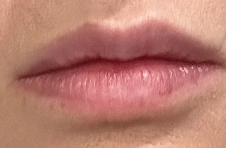 Lip fillers?