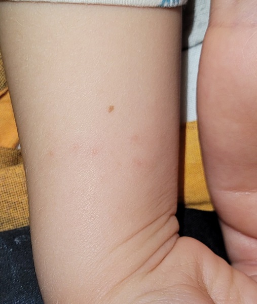 Rash - help my health anxiety