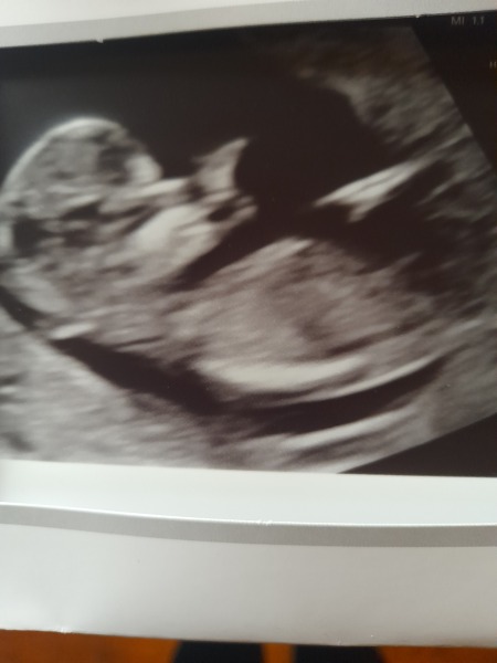 Nub theory guesses please 12 weel scan..Will update at 20 weeks