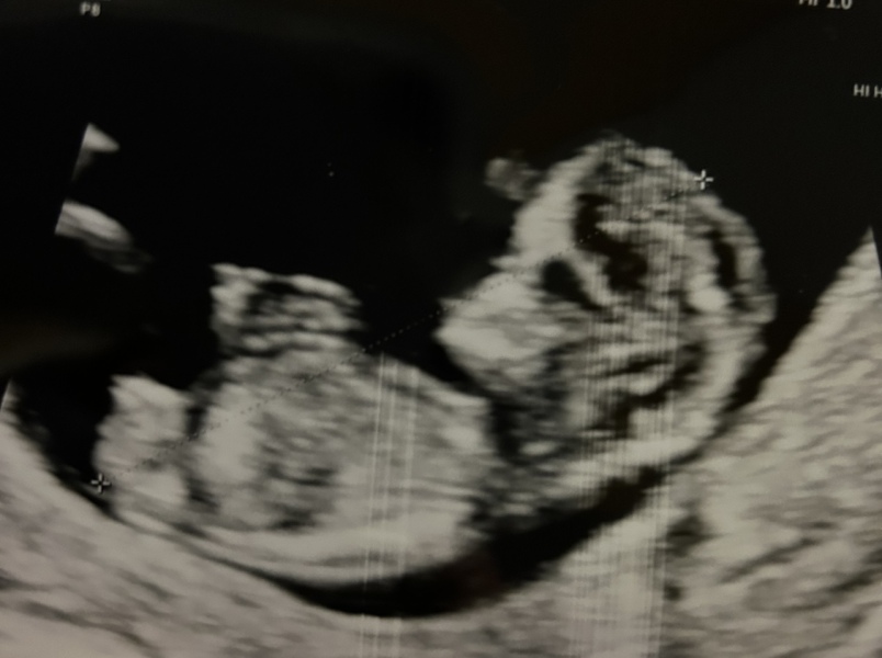 Screening tests in Northern Ireland