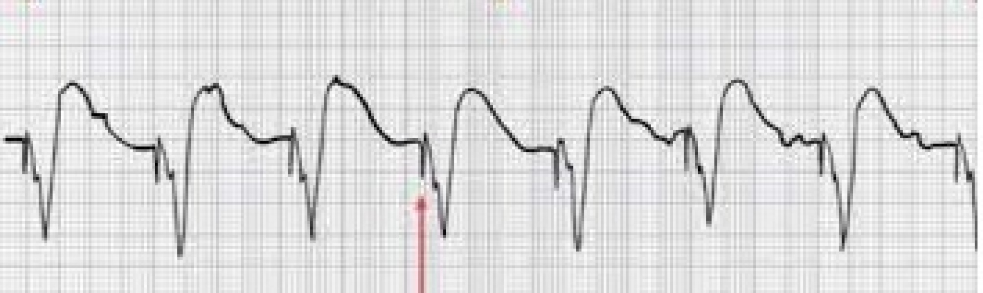 Is this ECG normal? Do I need to go to a&e?