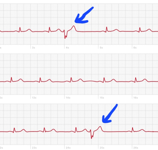 Is this ECG normal? Do I need to go to a&e?