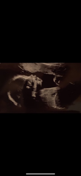 Do you think these ultrasounds are the same sex?