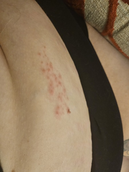 What is this rash?