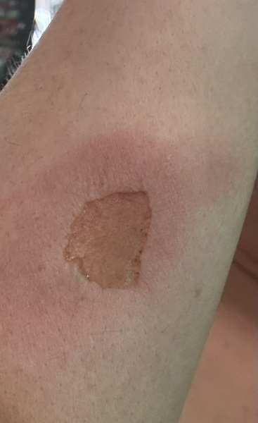 TW SELF HARM. Is this infected