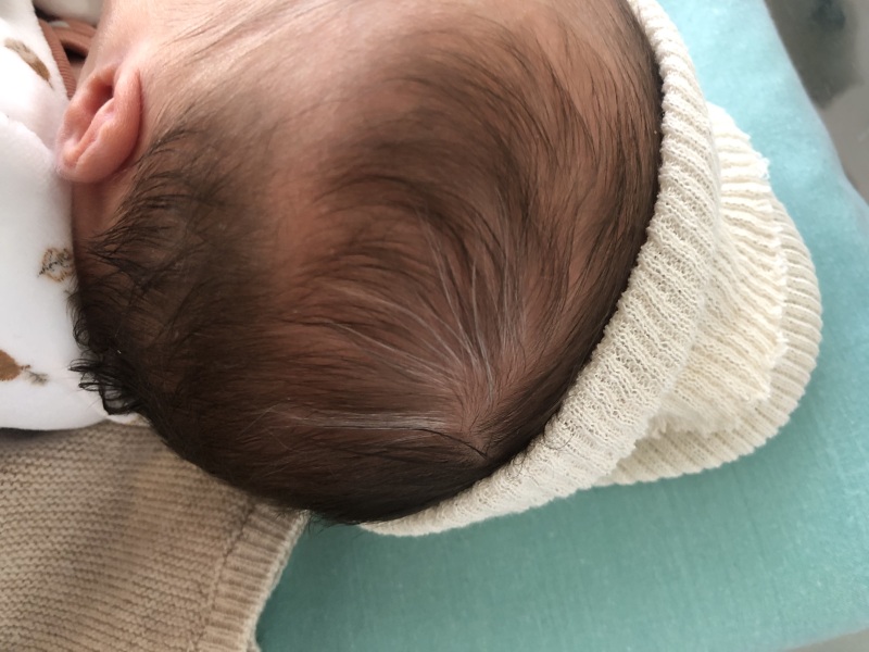 Very worried about newborn’s white hairs