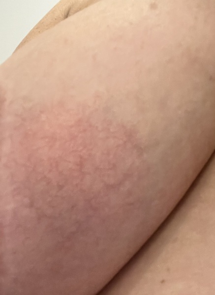 Breast infection