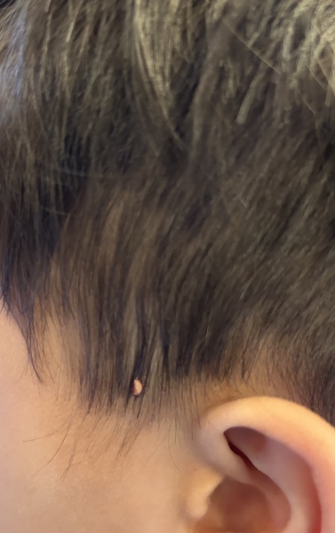 Weird spot on side of head