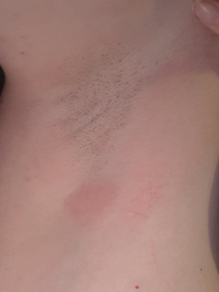 Spot/lump under armpit on the side of my boob, help