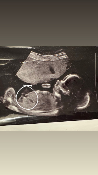Nub or umbilical cord?