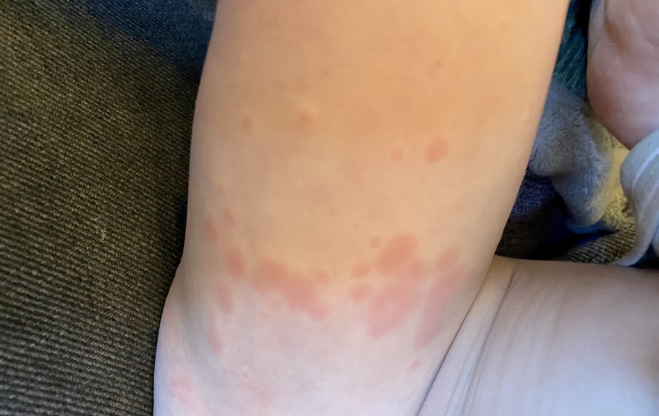 What is this rash?!