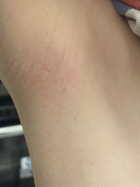 Should i be worried? Armpit non blanching spots