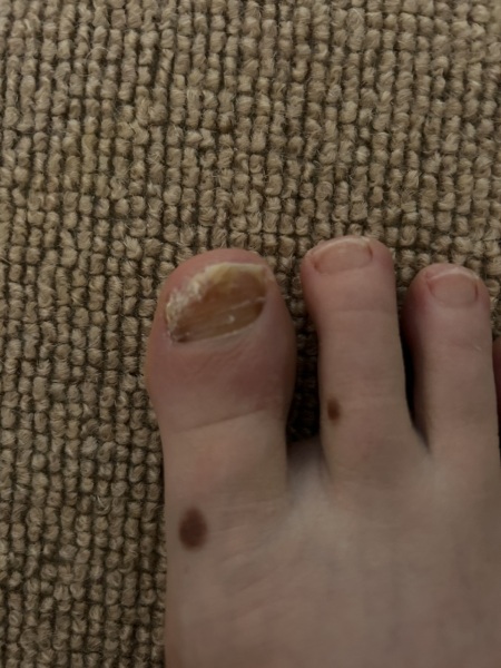 What is wrong with my manky toenail? Warning! Photos!
