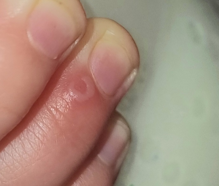 Start of Hand Foot and Mouth?