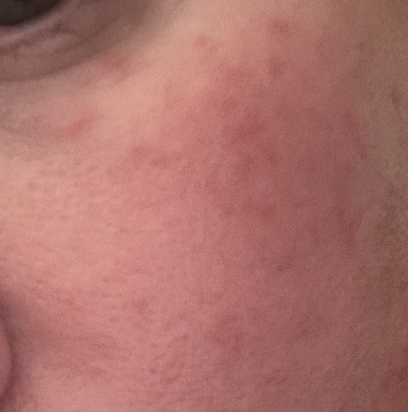 HELP! Age 40 and under eye/cheek bumps