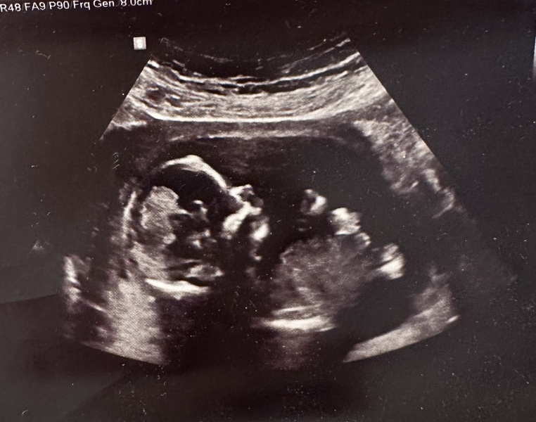 Boy or Girl - 14 week scan