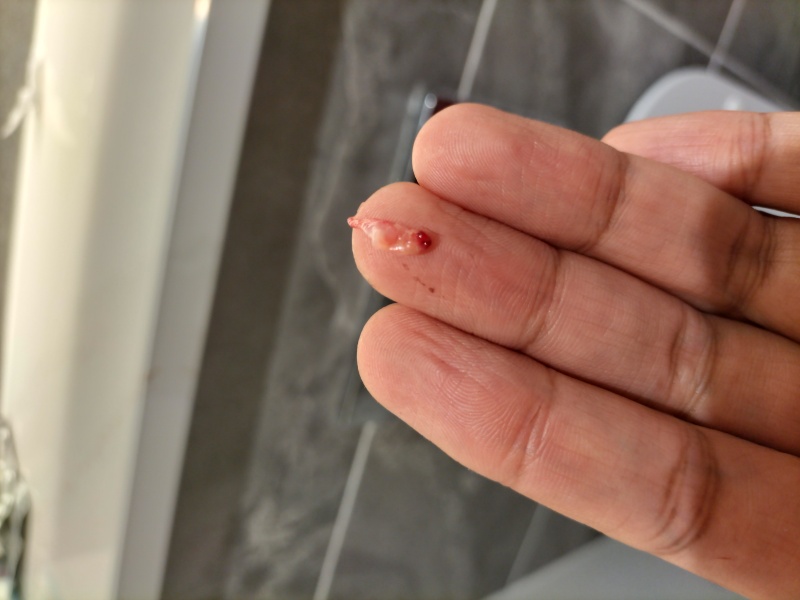 Have I miscarried? Photo. *trigger warning*