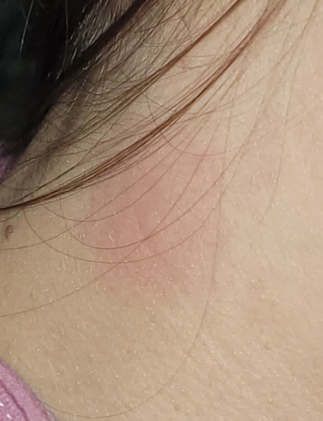 What is this on my neck?