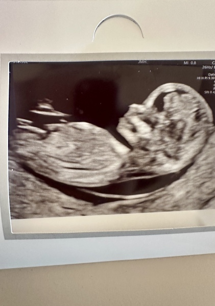 Nub theory guesses - girl or boy?