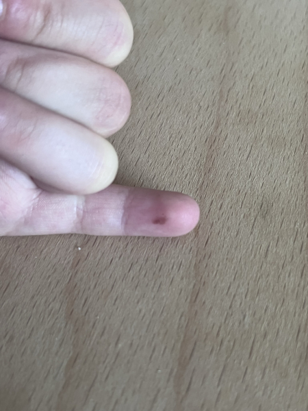 Birthmark/mole?