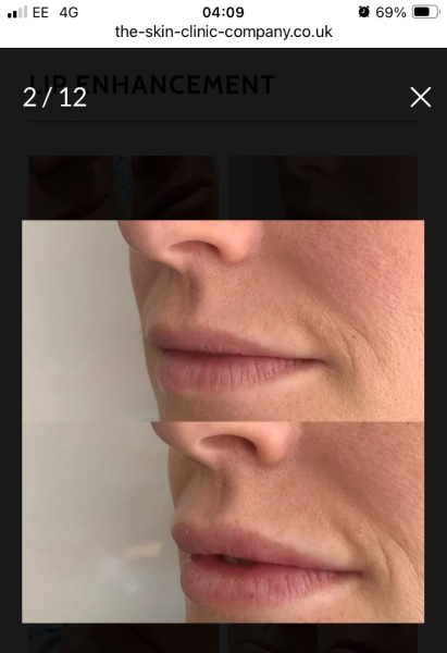 Lip fillers?