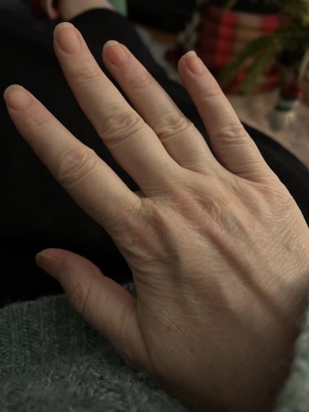 Puffy knuckles photo