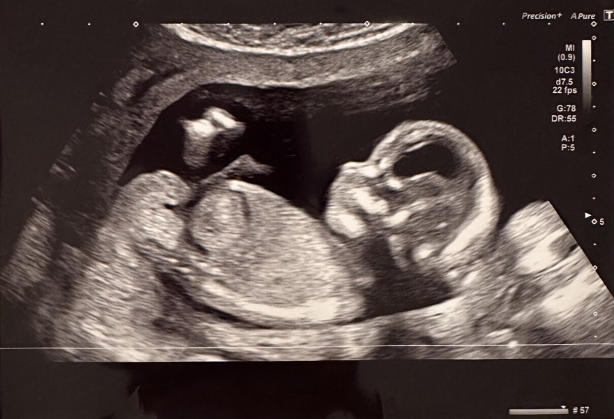 Girl or Boy 💖💙