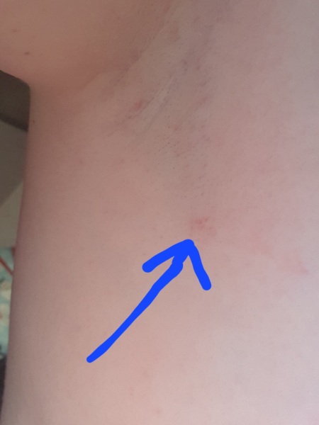 Spot/lump under armpit on the side of my boob, help