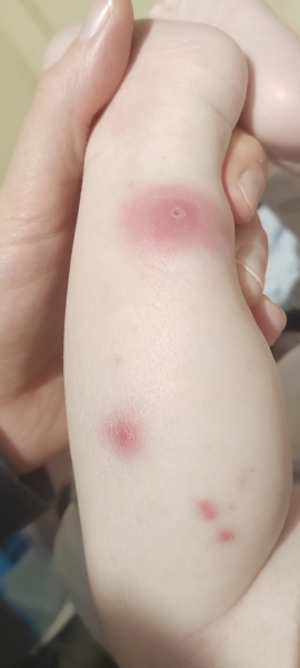 Cyst like bumps on 7 month old