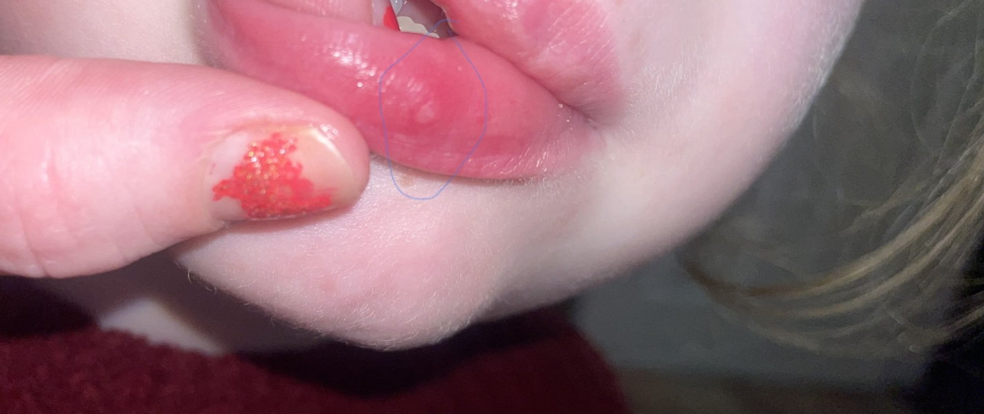 Is this a coldsore? Pics attached