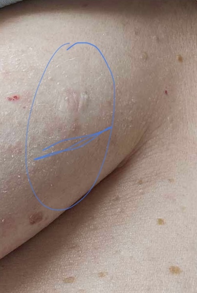 Extremely worried about this rash on my boob. IBC? Photos
