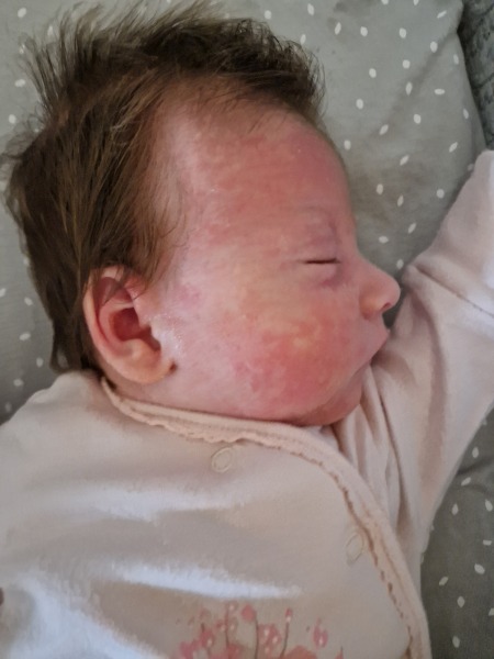 Red rash on baby's face - cradle cap?