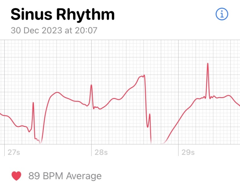 What’s going on with this ECG (Apple Watch)