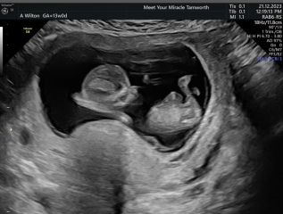 Boy or girl? 13 weeks
