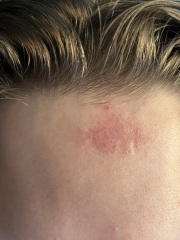 Eczema? Can you help ID this random patch please.