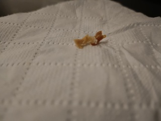 Fabulous earwax *tmi pic*