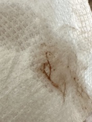 Am I miscarrying? TW:blood