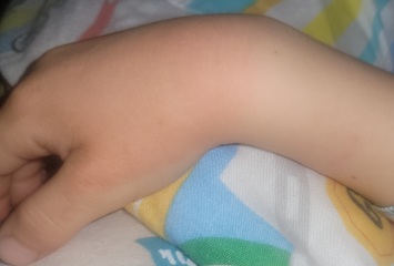 Rash - help my health anxiety