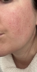 Does this look like rosacea?