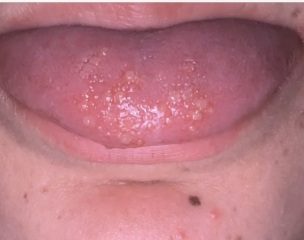 Mouth and throat ulcers - pics attached.